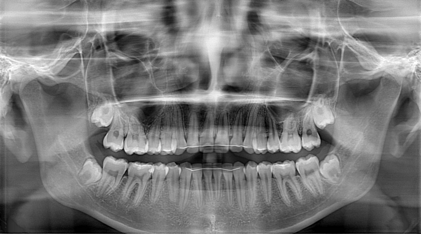 Pano xray taken at our office before wisdom teeth removal
