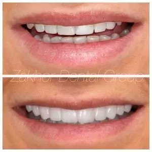Dentist Smile Gallery Before After Photos in Beverly Hills 