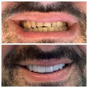 Dentist Smile Gallery Before After Photos in Beverly Hills 