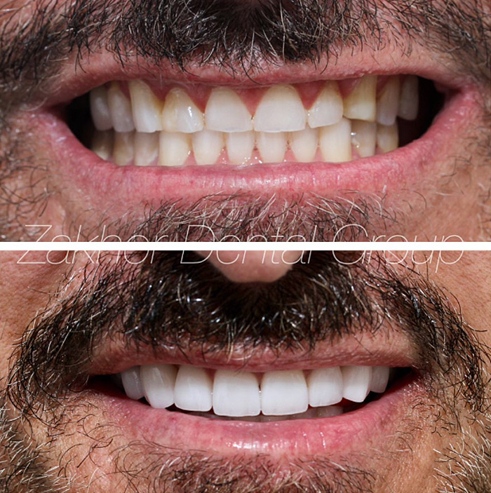 Porcelain Veneers FAQs Gallery Before After Photos in Beverly Hills 