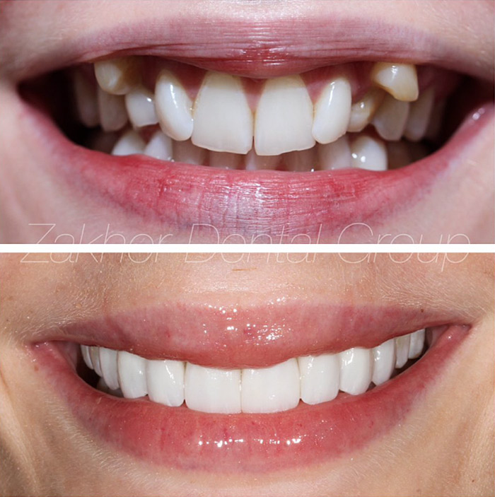 Porcelain Veneers Cost Gallery Before After Photos in  in Beverly Hills 