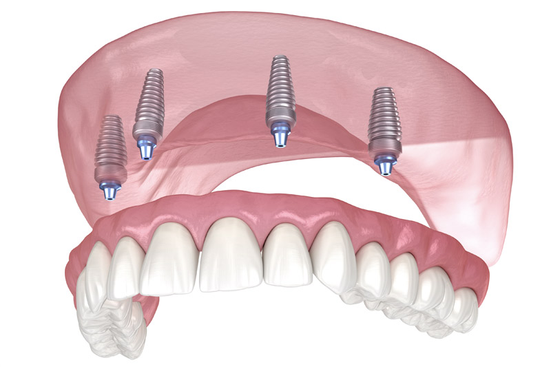All on 4 Dental Implants in Beverly Hills