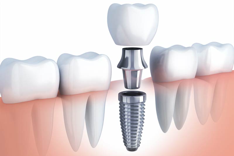 Implants Dentist in Beverly Hills