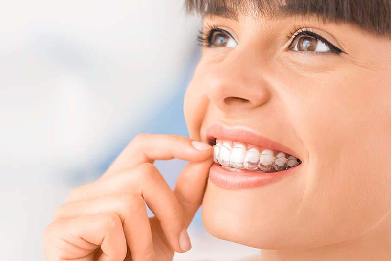 Invisalign Treatment in Beverly Hills