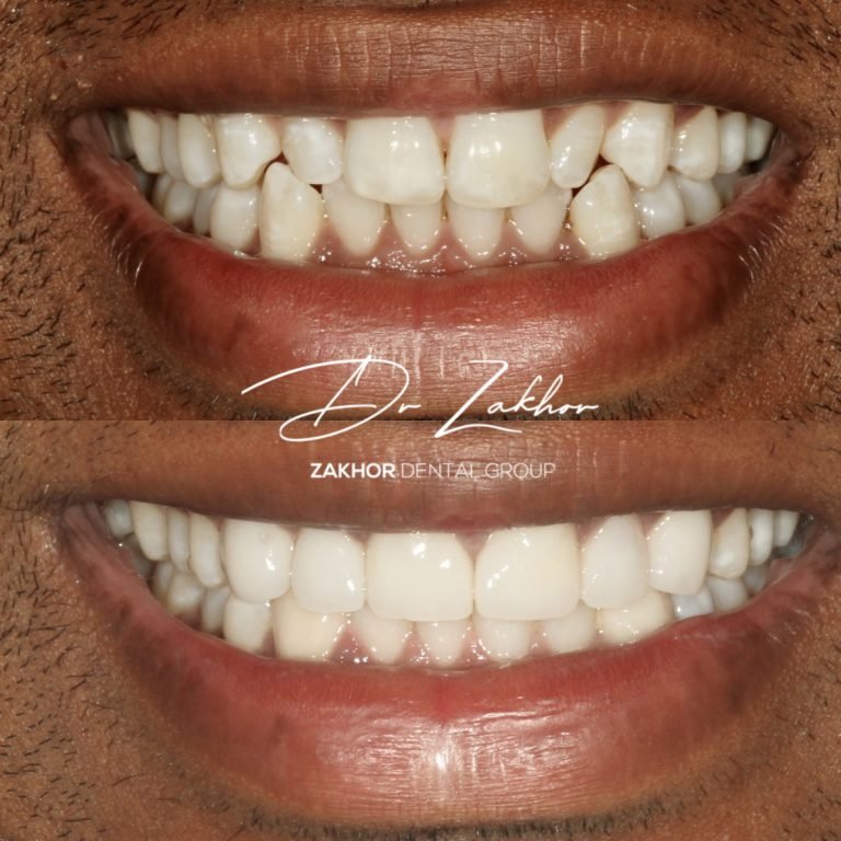 Transform Your Smile with Porcelain Veneers and Crowns: A Comprehensive Guide to Smile Makeovers