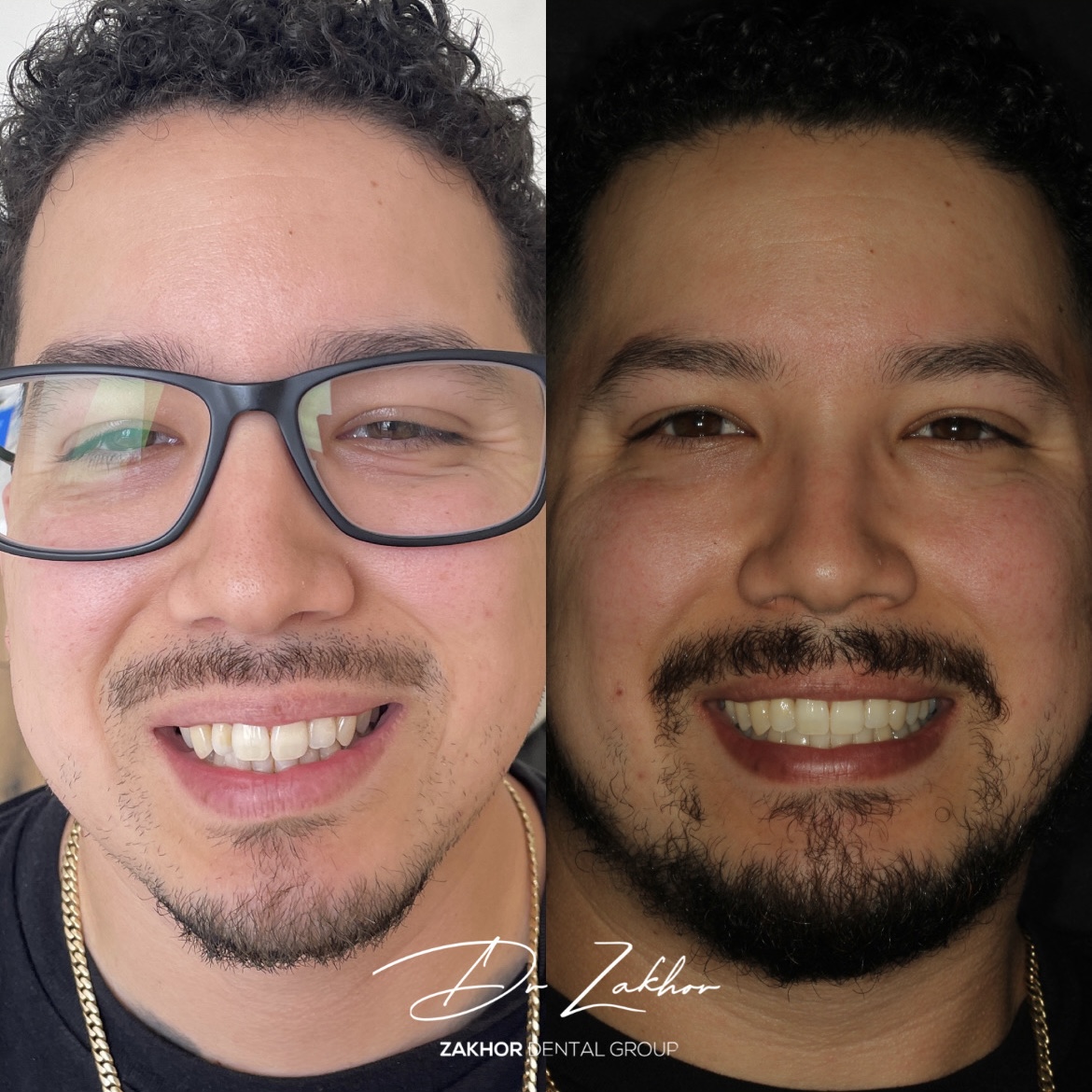 Before — patient smile