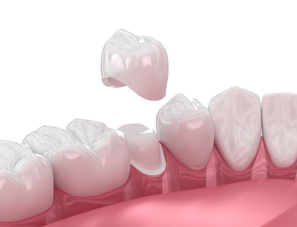 Dental-Crown