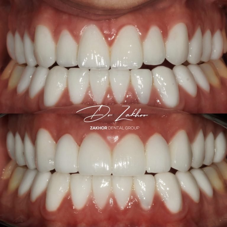 los-angeles-biomimetic-dentistry