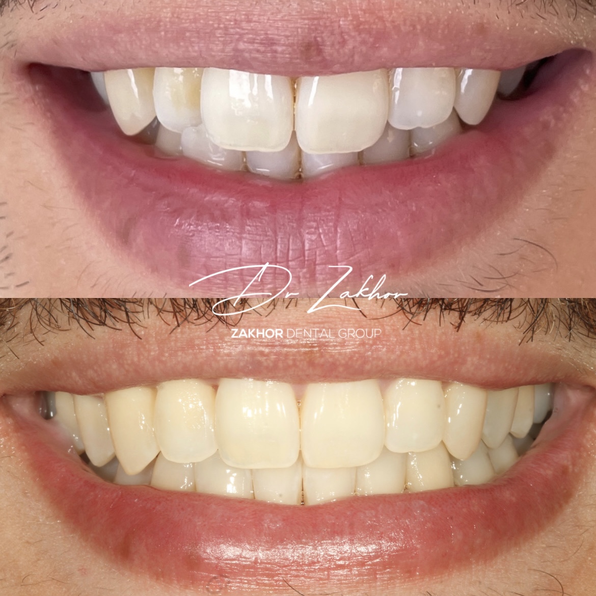 Los Angeles Invisalign dentist — Zakhor Dental Group