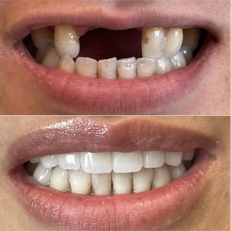 before gAZAZCXzakhor-dental-BH-dentistand after