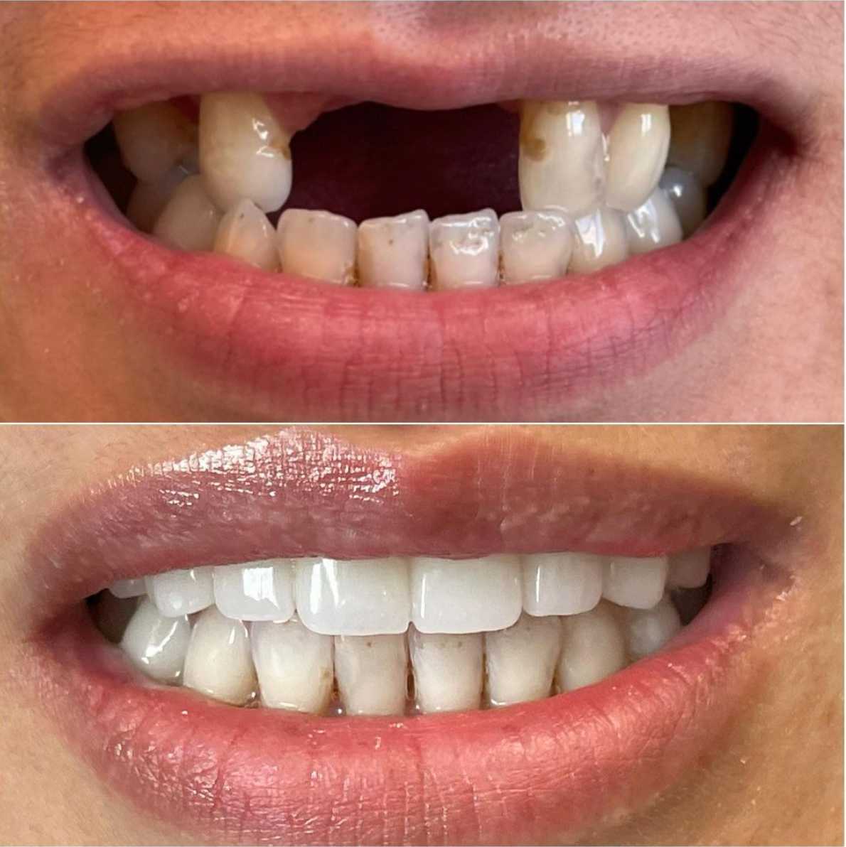 before gAZAZCXzakhor-dental-BH-dentistand after