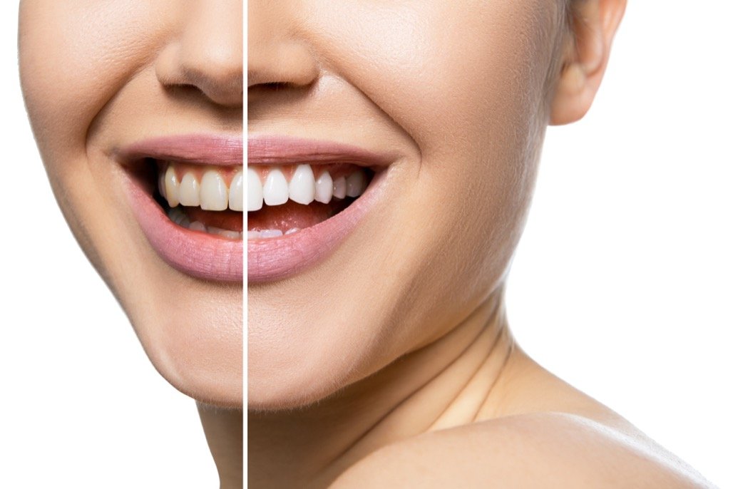 Teeth Whitening