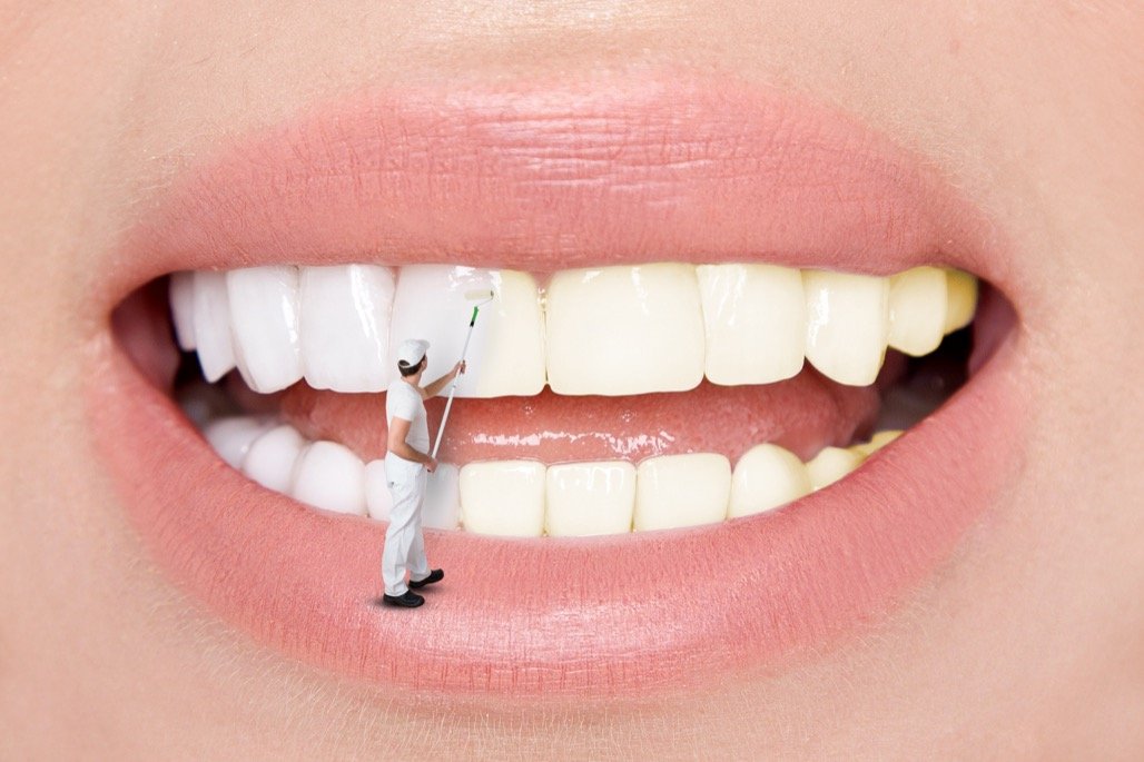 Teeth Whitening