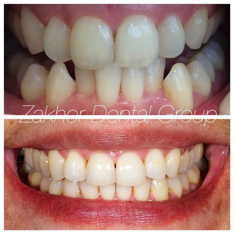 Invisalign vs. Porcelain Veneers or BOTH: Which One is Right for Your Perfect Smile?