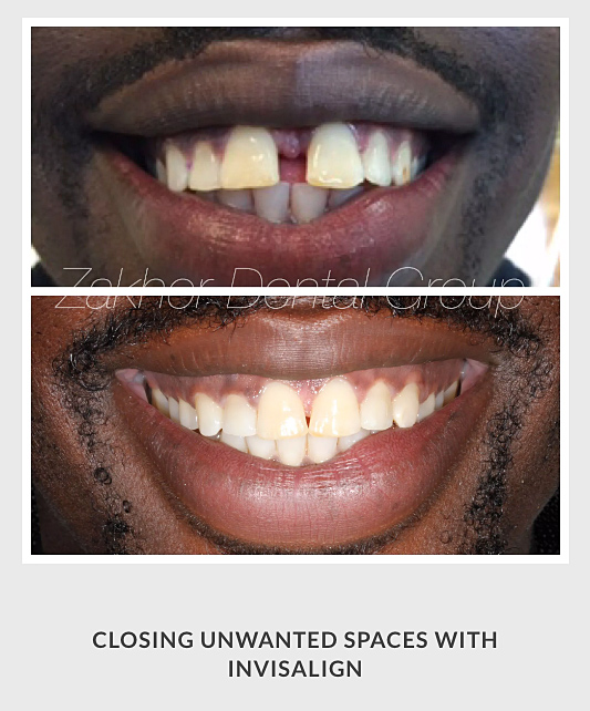 After — smile transformation