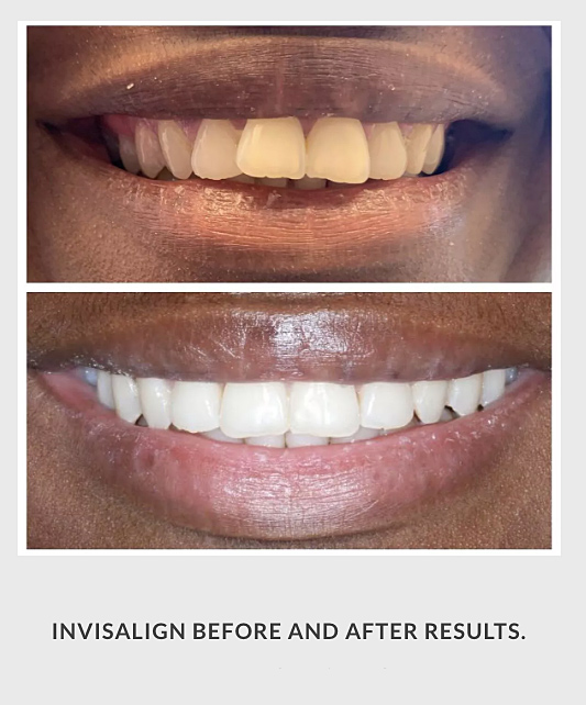 After — smile result