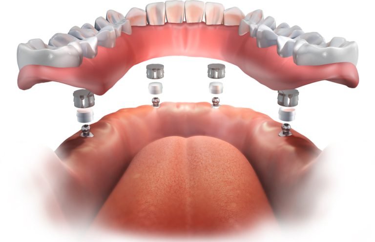 all-on-4 dental implant