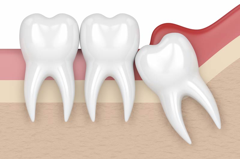 wisdom tooth extraction emergency dentist Los Angeles Beverly Hills