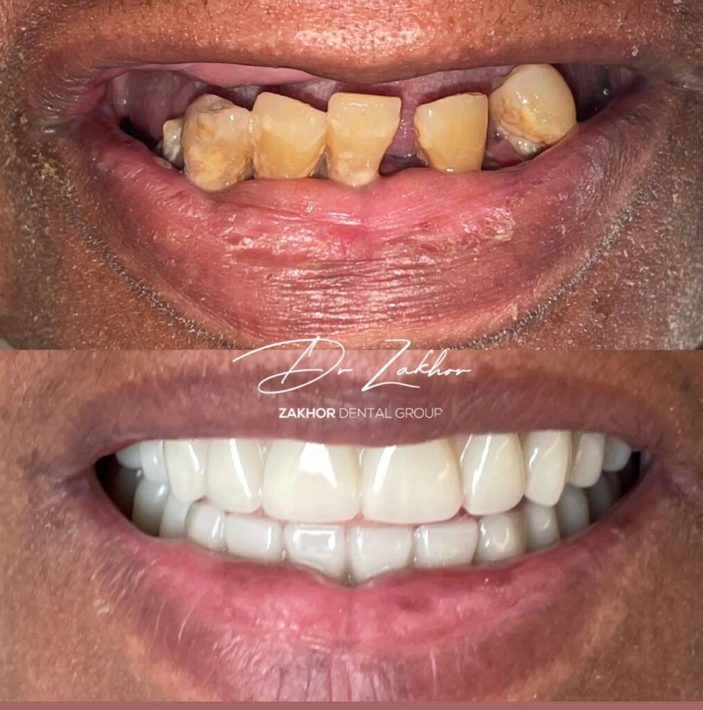 all-on-4 dental implants