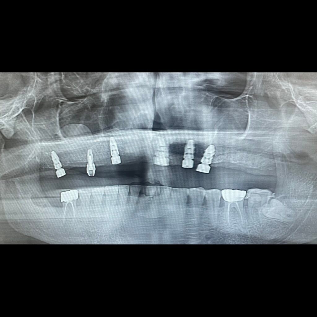 all on 4 implants pano xray