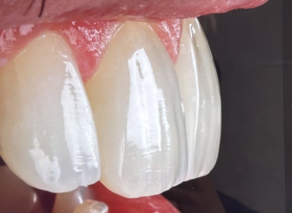 porcelain veneers beverly hills