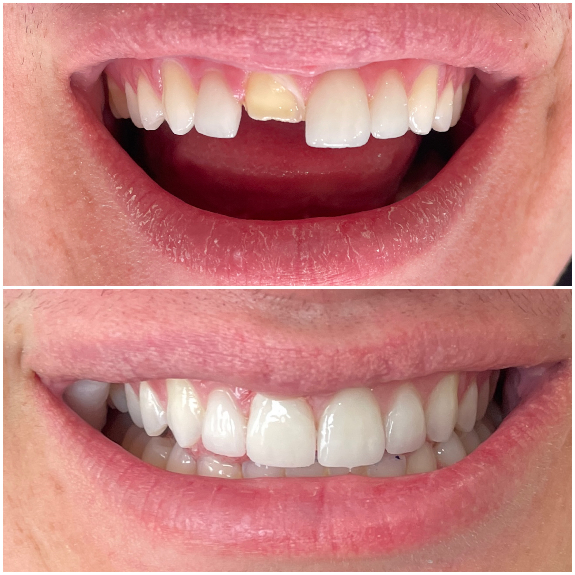 emergency dentist Los Angeles porcelain veneers before after Zakhor Dental