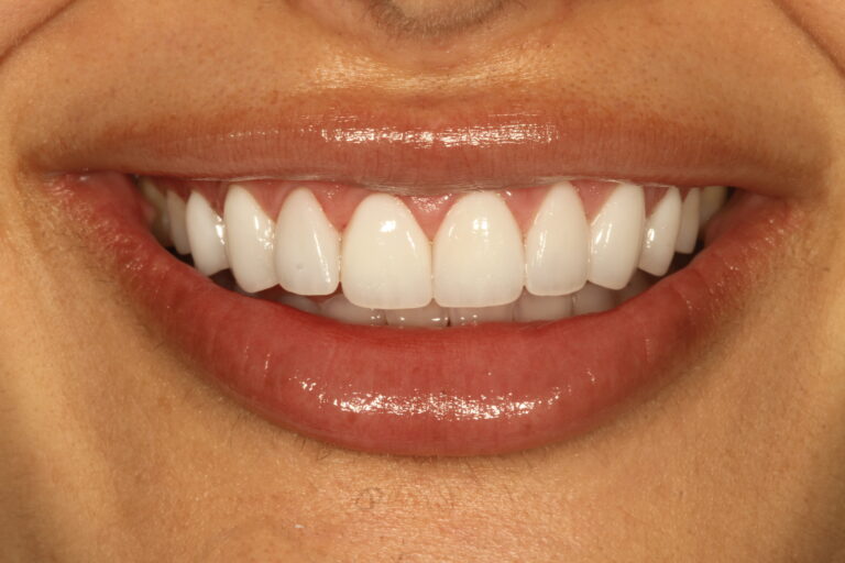 porcelain veneers beverly hills