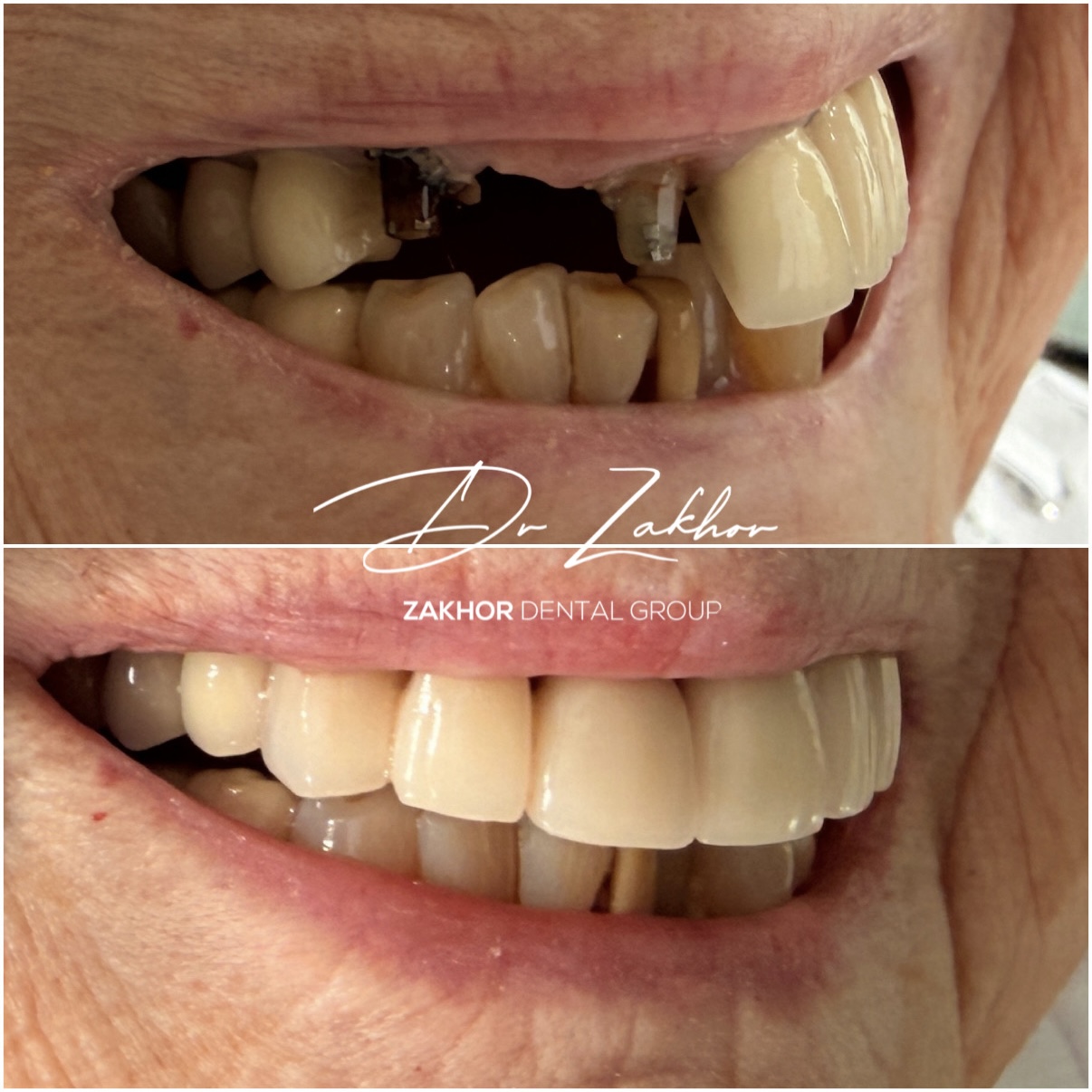 emergency dentist Los Angeles before after full arch restoration Zakhor