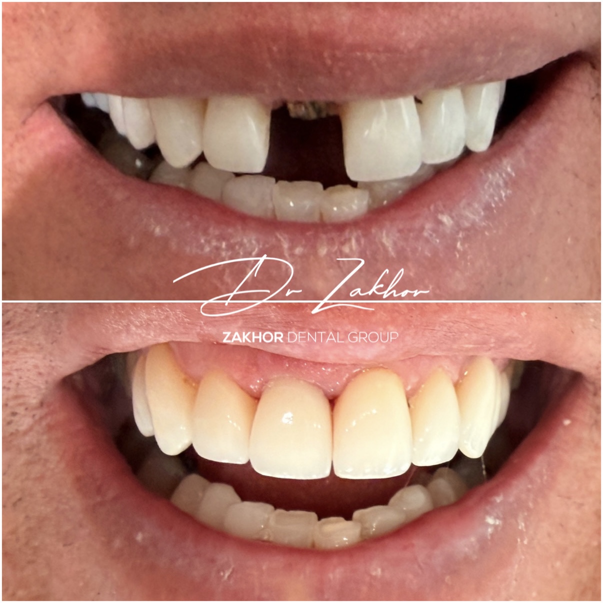 emergency dentist Los Angeles before after crown restoration Zakhor Dental