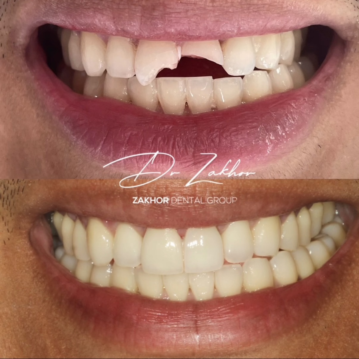 dental trauma restoration emergency dentist Beverly Hills Los Angeles