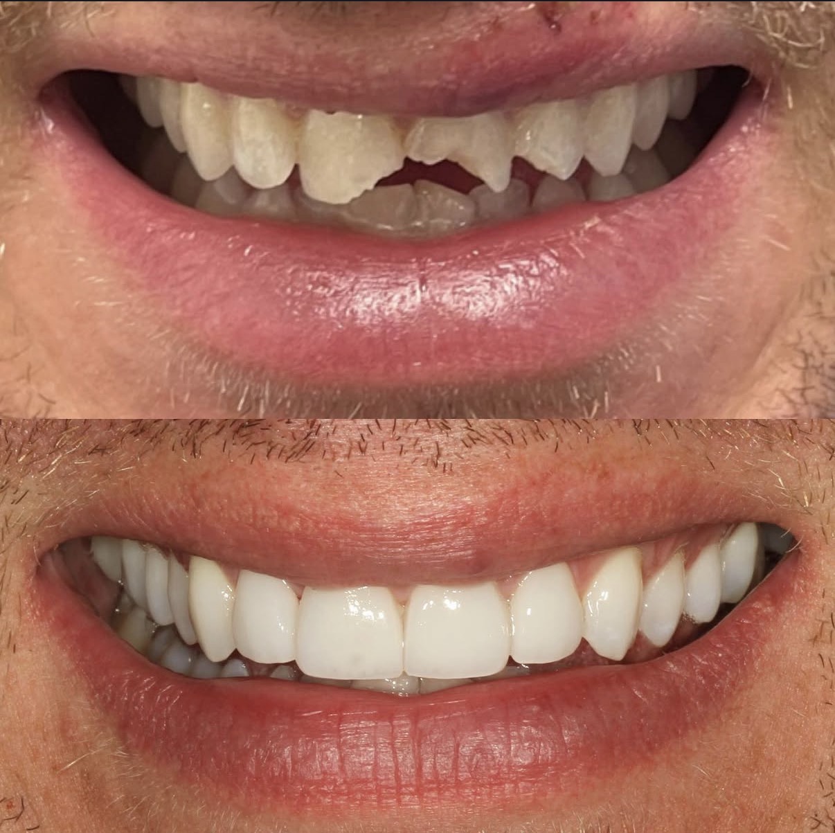 dental trauma case emergency dentist Los Angeles Beverly Hills