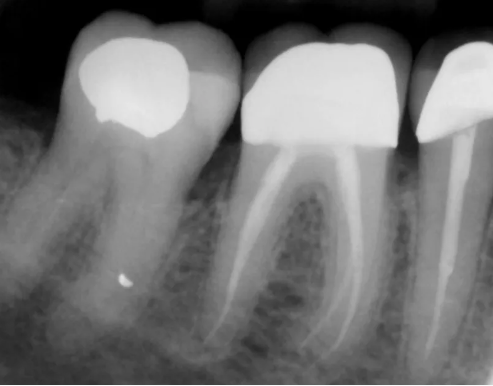 root canal therapy endodontist Los Angeles