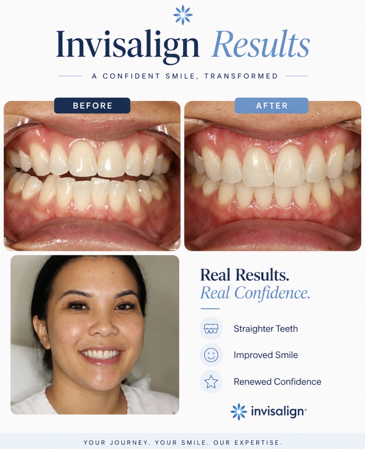 Invisalign clear aligner before and after Beverly Hills — Zakhor Dental Group