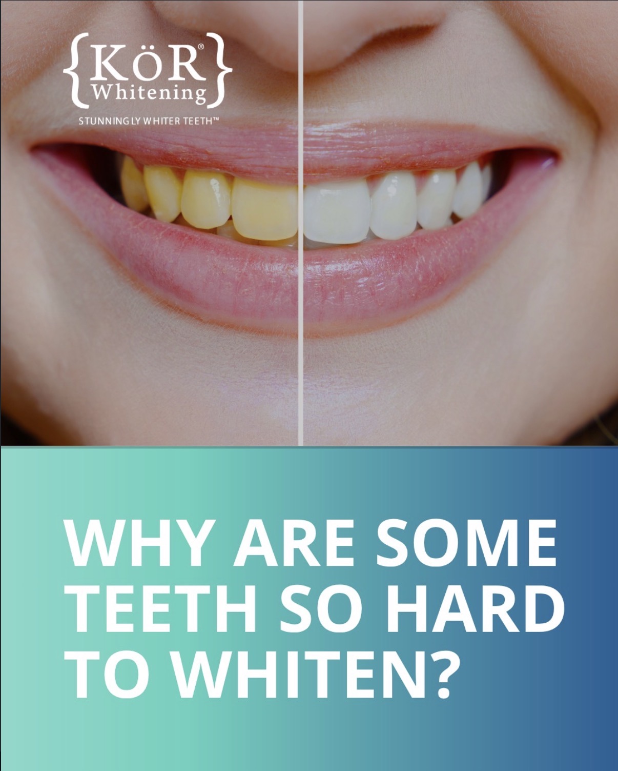 KöR whitening patient journey
