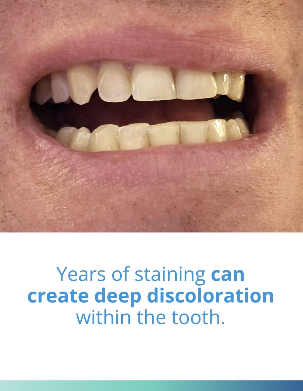 KöR whitening treatment