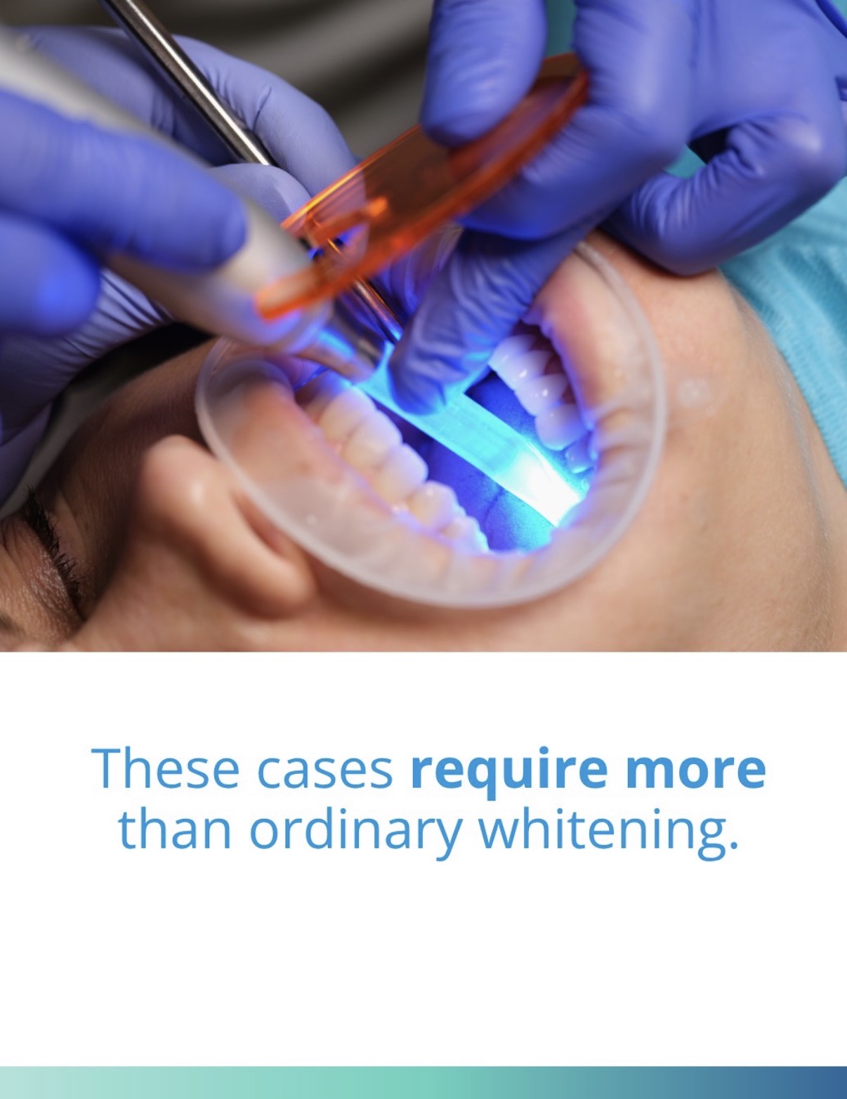 KöR whitening Beverly Hills