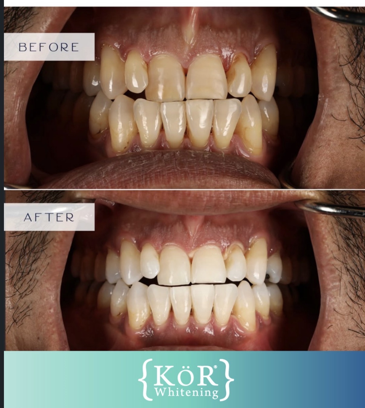 KöR whitening result