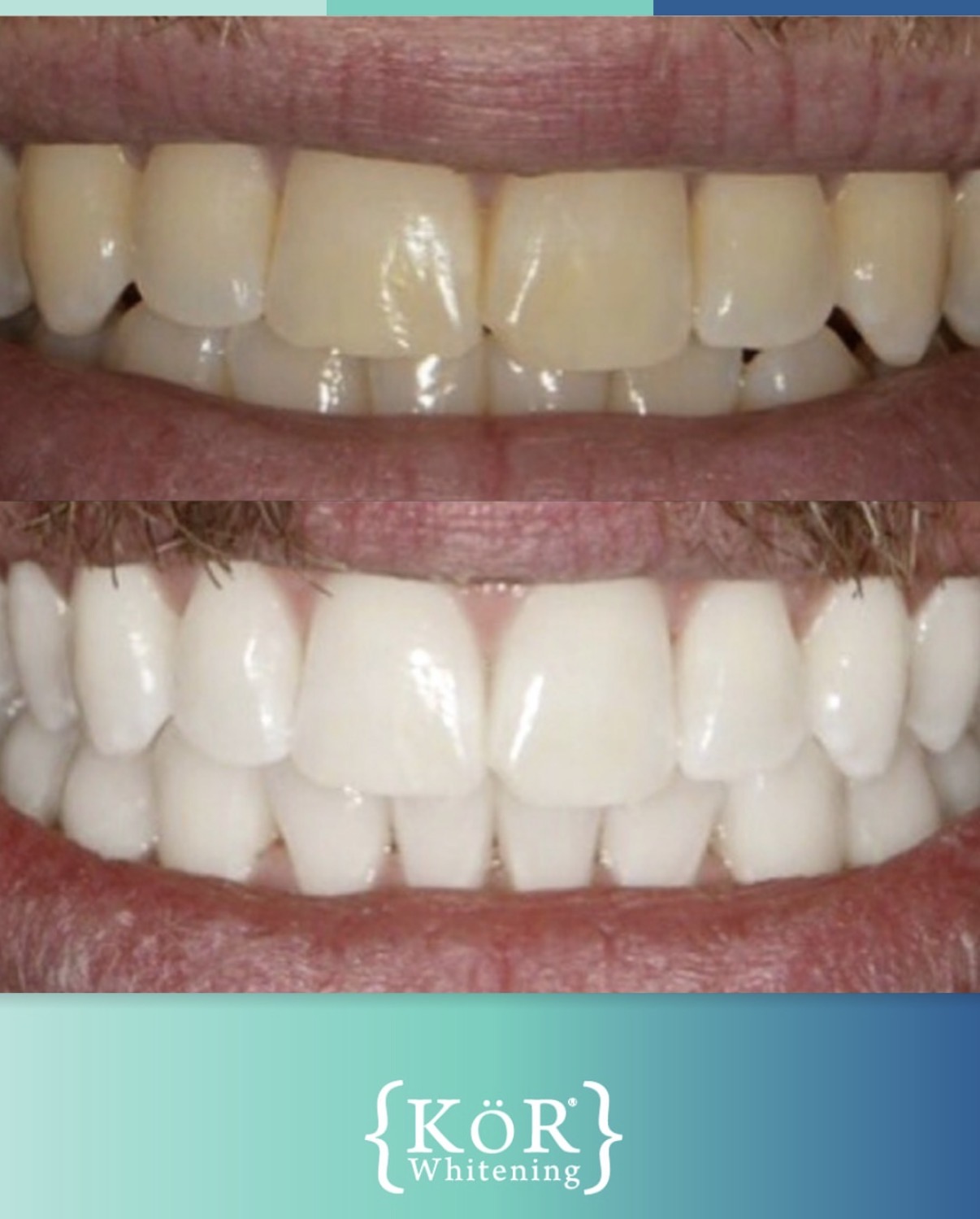 KöR whitening before and after