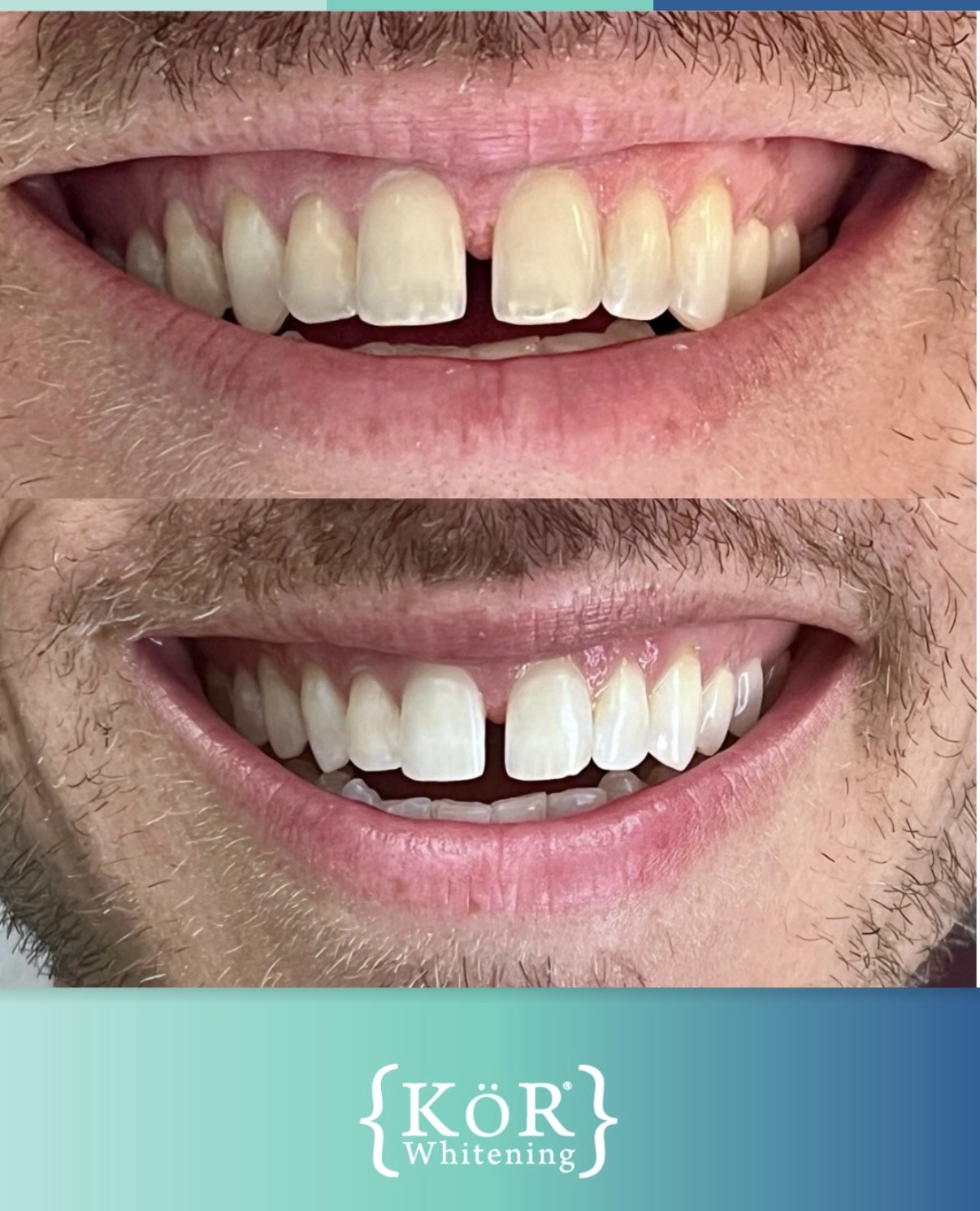 KöR whitening smile reveal
