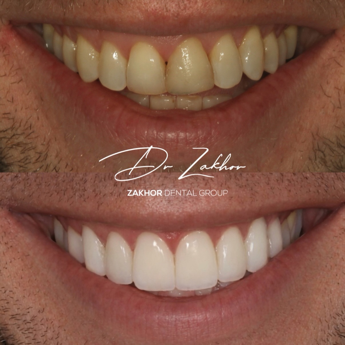 Porcelain veneers case Beverly Hills