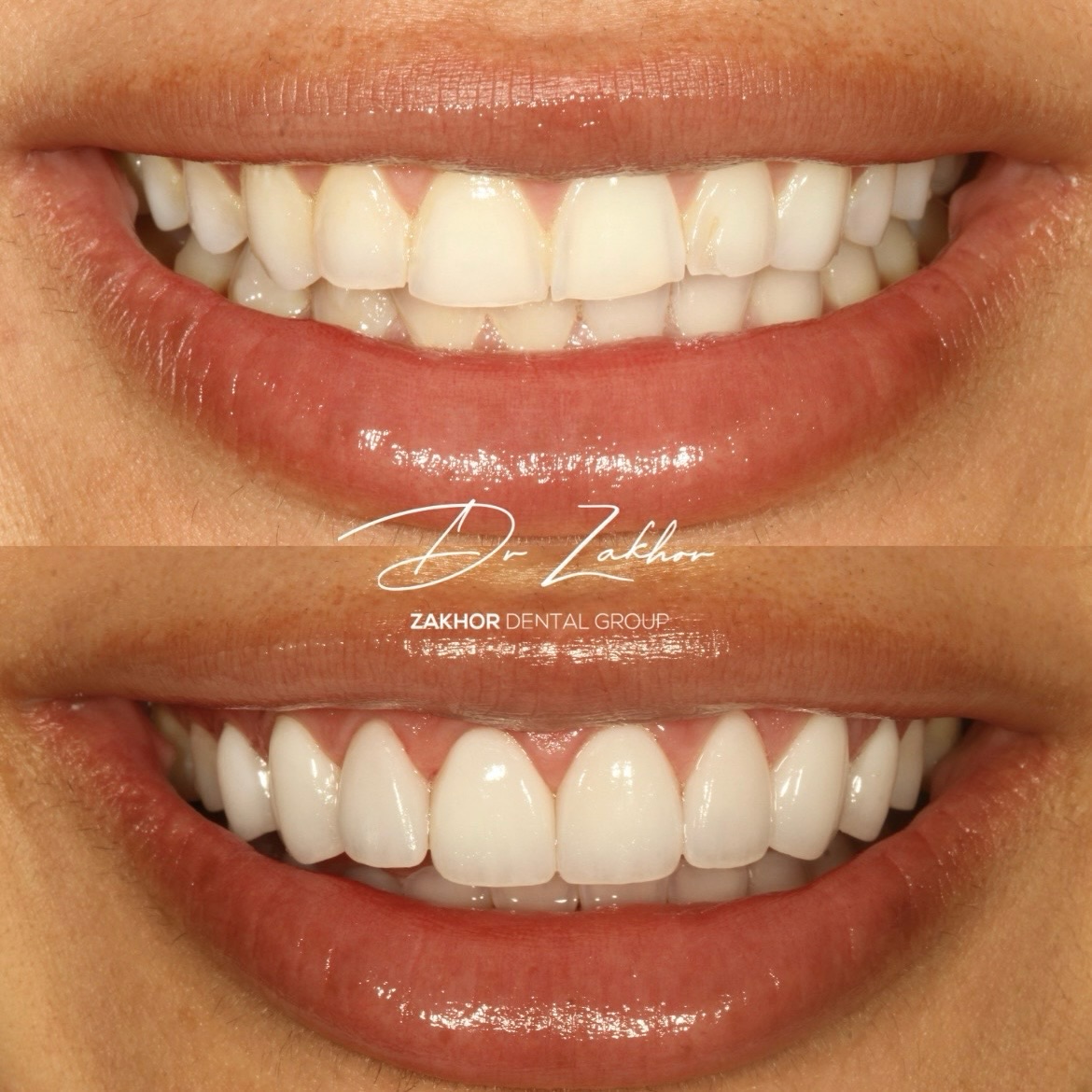 Porcelain veneers Beverly Hills